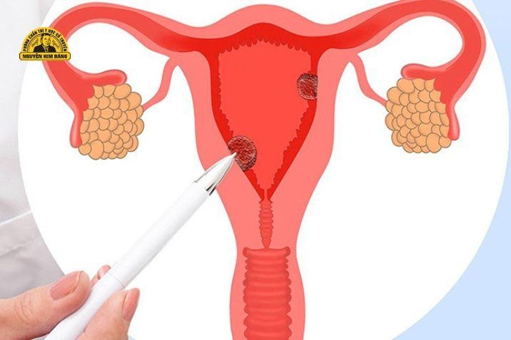 Đa nang buồng trứng là bệnh gì?
