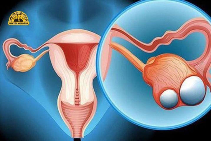 Lưu ý dành cho người mắc buồng trứng đa nang
