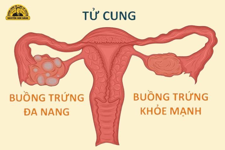 Đa nang buồng trứng là gì? 