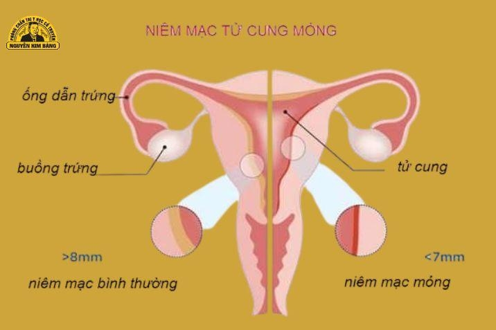Niêm mạc tử cung mỏng là gì?