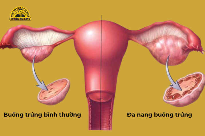 Làm sao để biết có bị đa nang buồng trứng không?