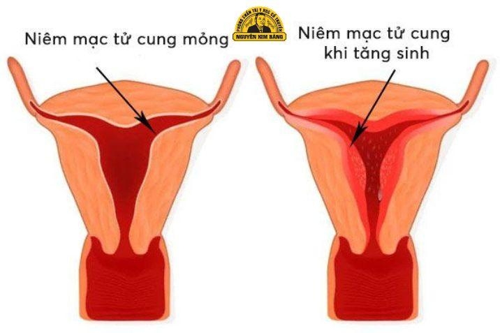 Niêm mạc tử cung mỏng là gì?
