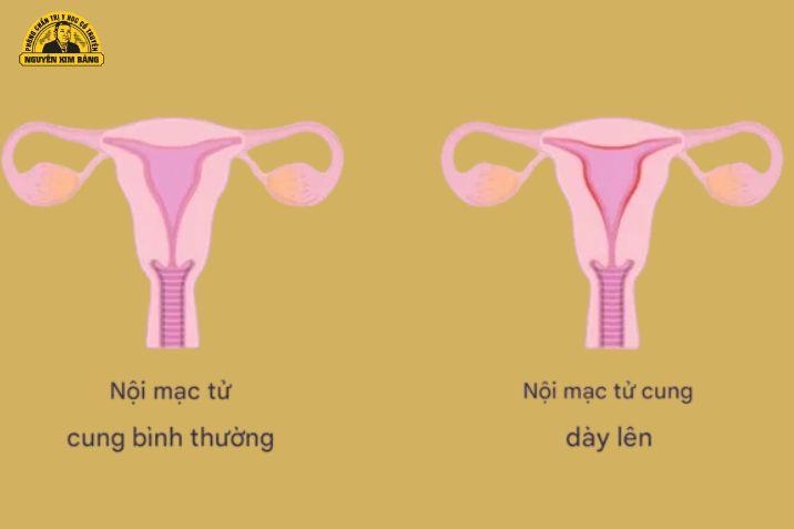 Nội mạc của tử cung dày có ảnh hưởng gì đến việc có thai?